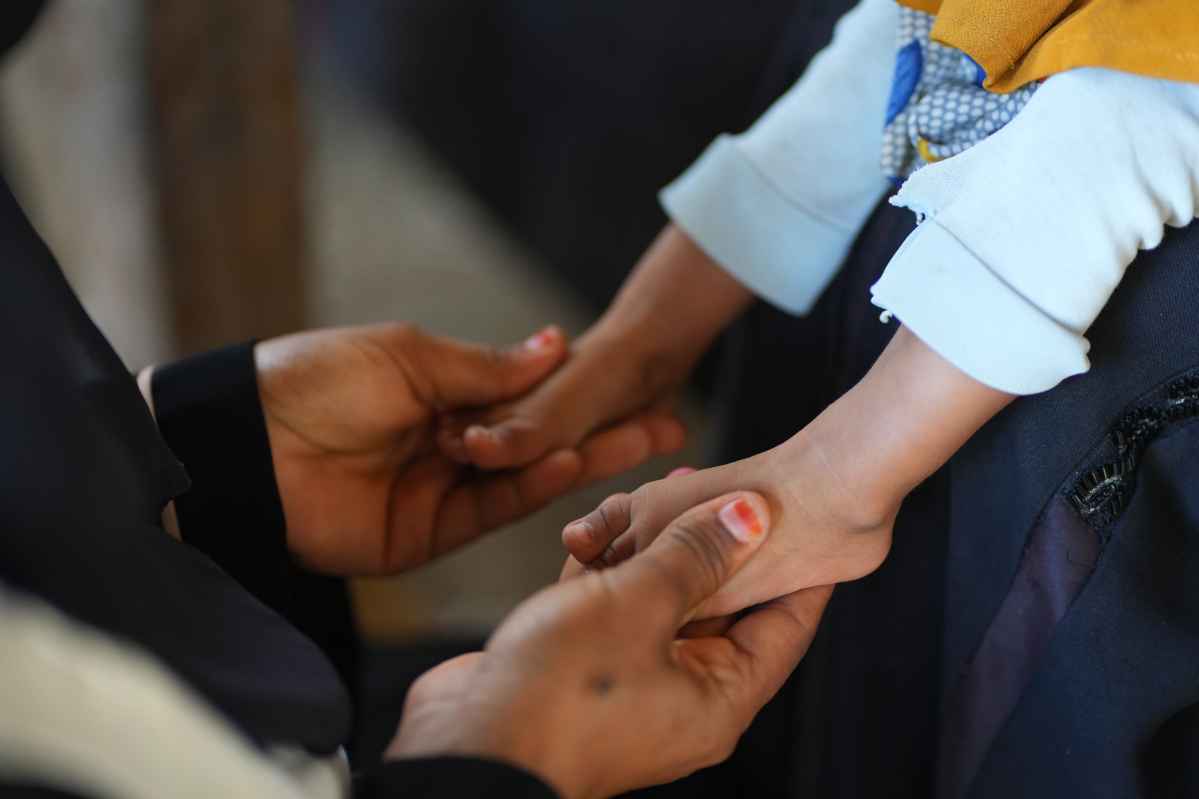 Detalle pies bebé tratamiento desnutrición